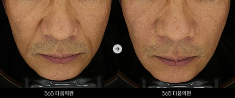 팔자 주름